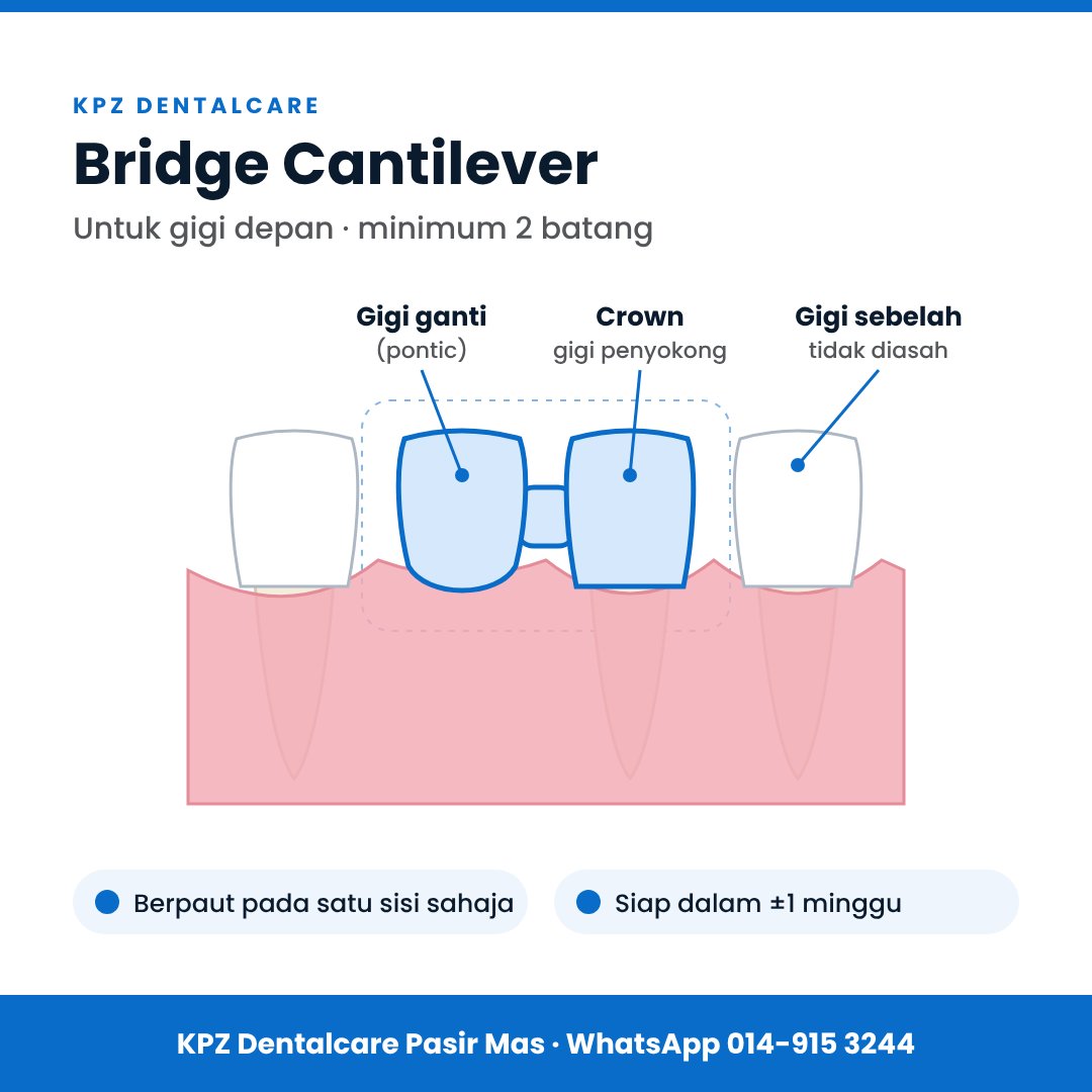 Bridge cantilever 2 batang untuk gigi depan: gigi ganti berpaut pada satu crown penyokong.