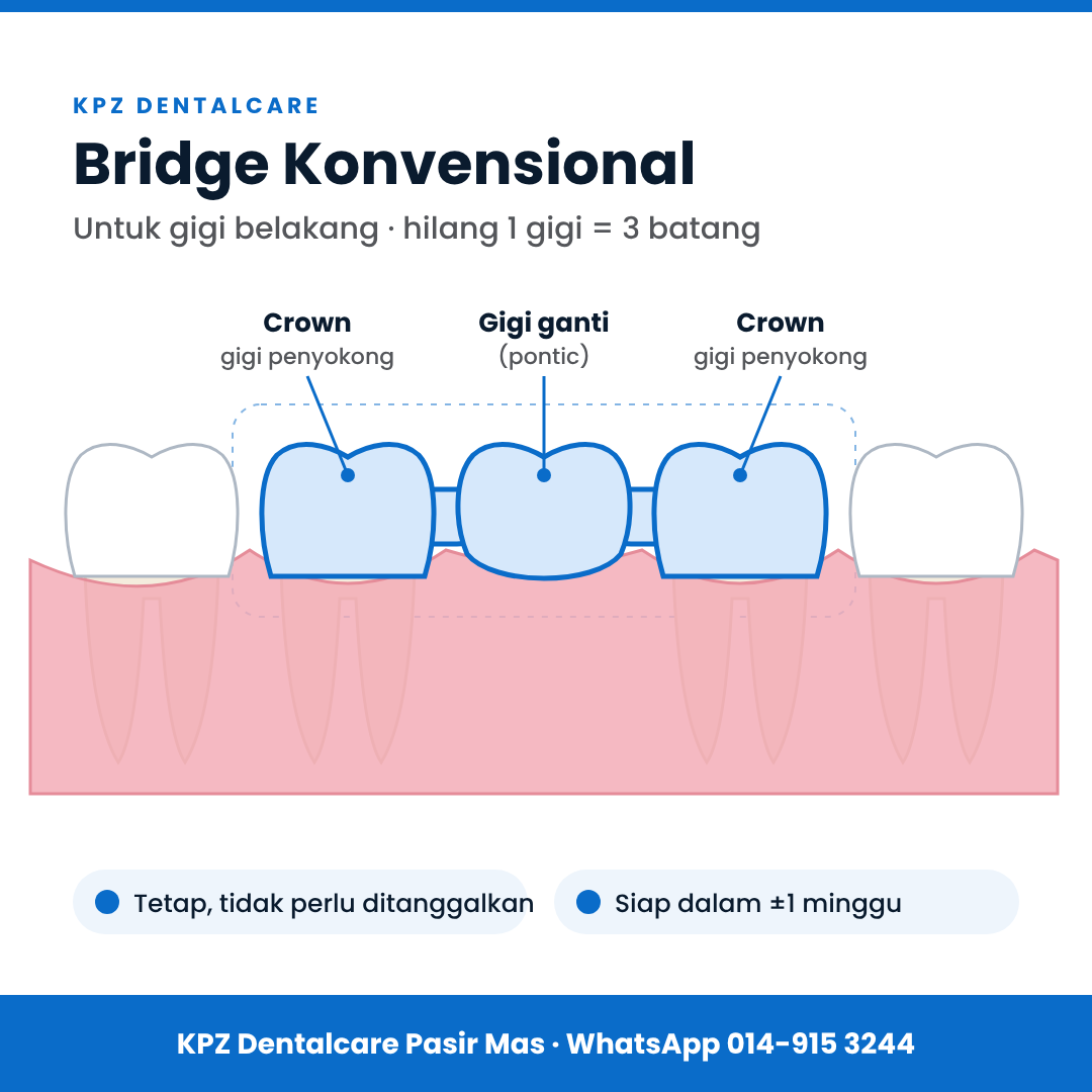 Bridge konvensional 3 batang: crown pada gigi penyokong kiri dan kanan, gigi ganti di tengah.