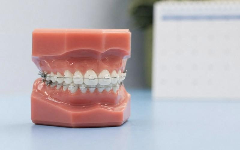 Pendakap Gigi (Braces)